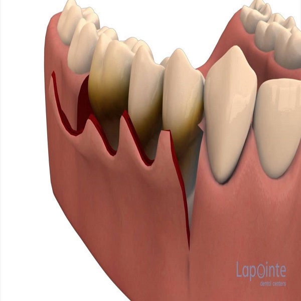 Best Periodontal surgery clinic in Dubai UAE - Arizona - Mesa ID1590618