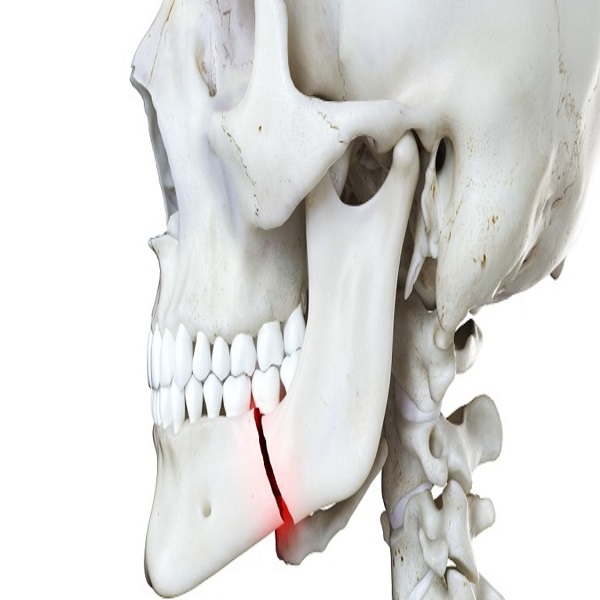 Best Jaw Fractures treatment in Dubai UAE - District of Columbia - Washington DC ID1590986