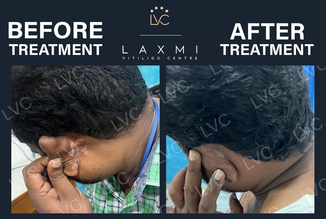  Effective Vitiligo  Leucoderma Cure - Tamil Nadu - Madurai ID1614847