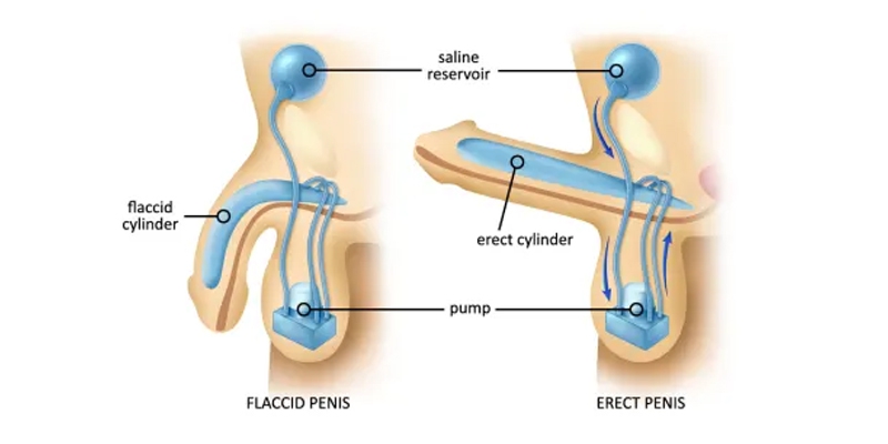 Erectile Dysfunction Treatments - California - San Diego ID1588621