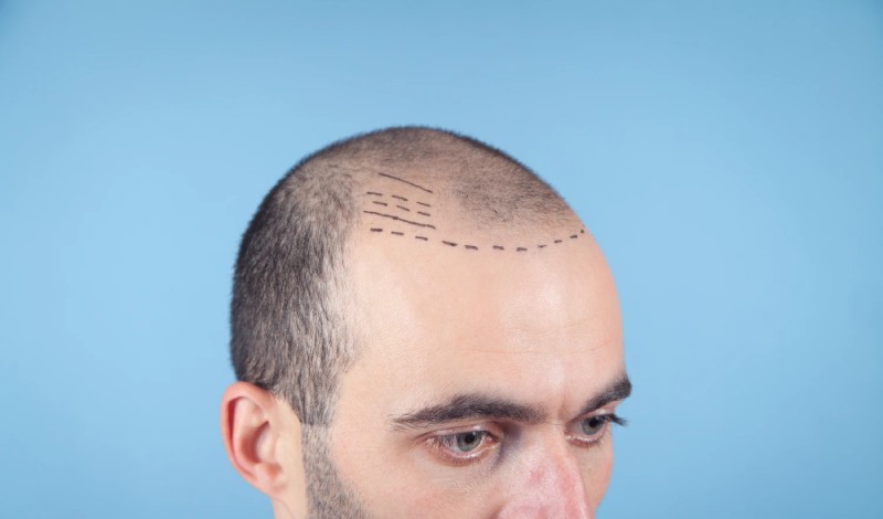 Best Hair Transplant in Chhattisgarh  Saluja Skin Clinic - Chhattisgarh - Bilaspur ID1611687