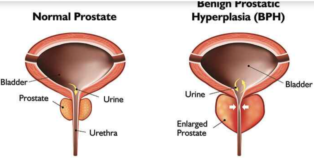 Most Effective Benign Prostate Hypertrophy Treatment - California - Santa Ana ID1546652
