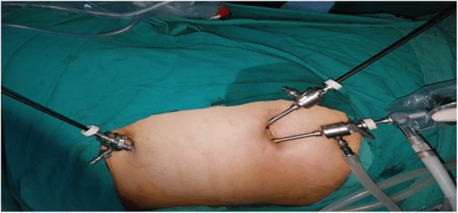 Top Hospital for Laparoscopic Gallbladder Surgery in Kolkata - West Bengal - Kolkata ID1604658