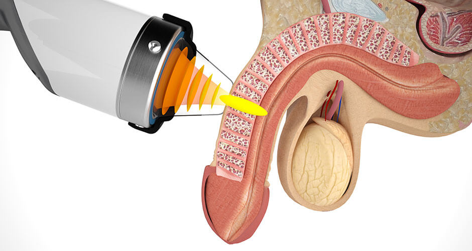 Erectile Dysfunction Treatments - California - San Diego ID1585141