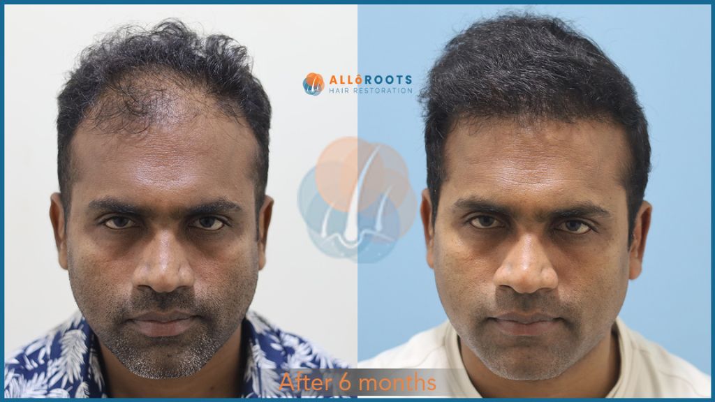 Hair Transplant Cost in Bhubaneswar  Alloroots  - Orissa - Bhubaneswar ID1537706