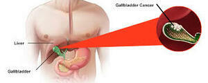 Advanced Gallbladder Cancer Care in Ludhiana with Dr Nitin  - Punjab - Ludhiana ID1600865