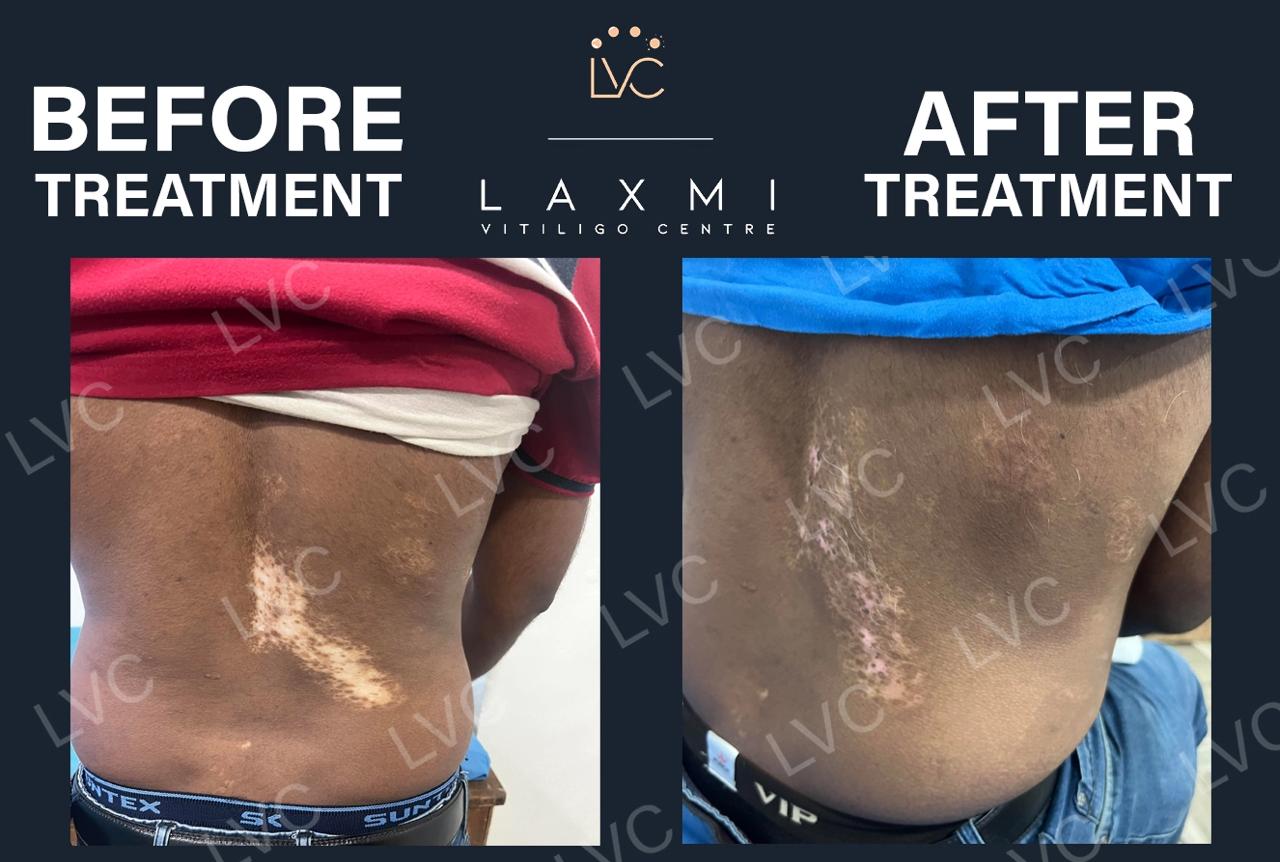 Effective Vitiligo  Leucoderma Cure - Tamil Nadu - Madurai ID1614286 2