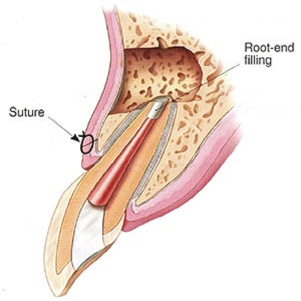 Best Root end surgery treatment in Dubai UAE - Connecticut - Stamford ID1589129