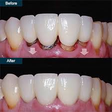 Thousands Fired Their Dentist After Using This Volcani - California - Santa Monica ID1518420 4