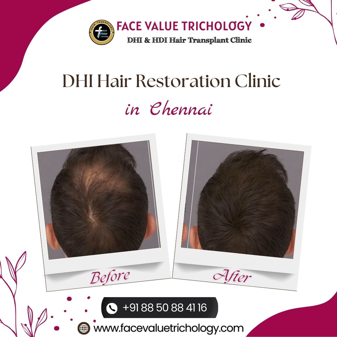 DHI Hair Transplant Clinic in Chennai - Tamil Nadu - Chennai ID1595980 2