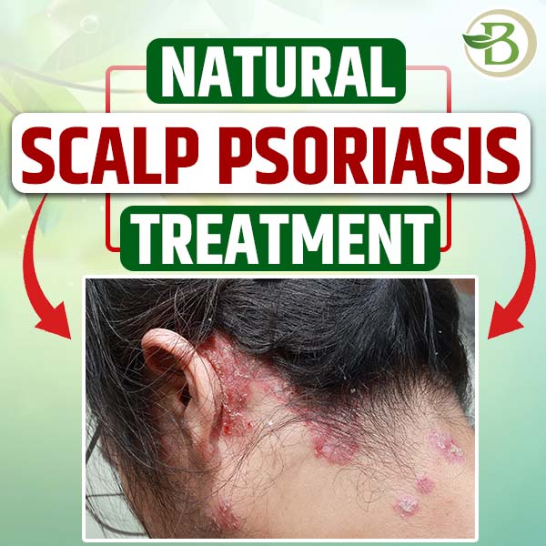 Achieving a Permanent Solution for Psoriasis Naturally Effe - Haryana - Gurgaon ID1561753