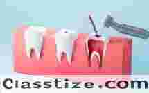 Trusted Dental Care for Root Canal Treatment in Chetla