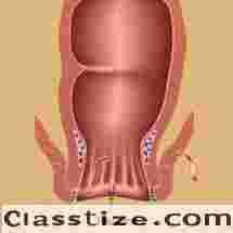 Expert Fissure Surgeon in Kolkata for Lasting Relief