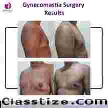 Top Gynecomastia treatment in Hyderabad 2024