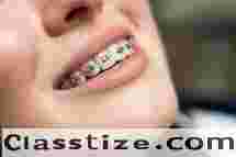 Best Dental Brace in Chetla for a Perfect Smile