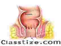 Expert Fissure Surgeon in Kolkata for Advanced Treatment
