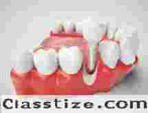 Restore Your Smile at a Dental Implant Clinic in Chetla