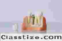 Top Dental Implant Clinic in Newtown – Trusted Specialists