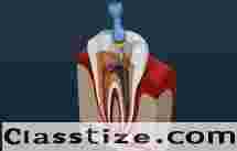 Trusted Root Canal Care for Lasting Dental Comfort in Chetla
