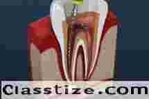 Expert Root Canal Treatment in Chetla for Healthy Smile  