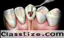 Best Root Canal Treatment in Chetla for Healthy Teeth  