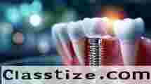 Best Dental Implant Clinic in Chetla – Expert Care  