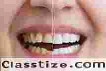 Affordable chandler cosmetic dentistry – Smile Makeovers in Chandler AZ