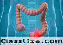 Managing Intestinal Malignancies with Dr. Jigar Patel