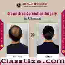 Top Hair Replacement Services in Chennai