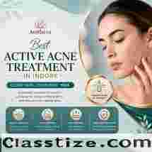  Best Active Acne Treatment in Indore - Aestheva 