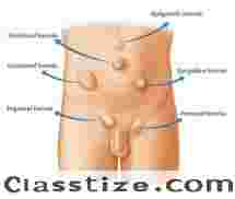 Laparoscopic Ventral Hernia Surgery in Delhi – Advanced Mesh Repair