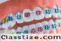 Best Dental Braces in Chetla for Perfect Smile  