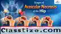 Stages of Avascular Necrosis Hip – Symptoms & Treatment