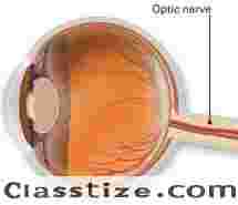 Looking for Optic Nerve Atrophy Care in Delhi? Consult an Eye Specialist Today