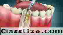 Advanced Root Canal Treatment in Chetla  