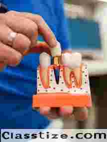 Advanced Dental Implant Clinic in Chetla  
