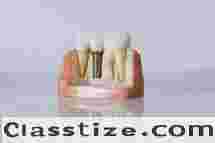 Best Dental Implant Clinic in Chetla for Confident Smiles  