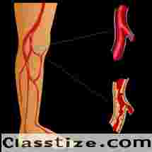 PAD Specialist – Expert Care for Peripheral Artery Disease