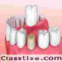 Best Cosmetic crown clinic in Dubai UAE