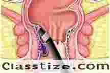 Best Fissure Surgeon in Kolkata for Expert Treatment  