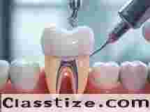 Best Root Canal Treatment in Chetla for Pain-Free Care