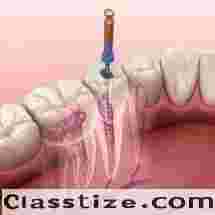 Advanced Root Canal Care in Chetla  