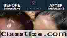 Effective Vitiligo & Leucoderma Cure