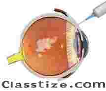 Need Macular Degeneration Treatment in Delhi? Book an Eye Consultation Today