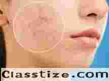 Best Acne Treatment in Bhubaneswar | Dr Partha Mohapatra