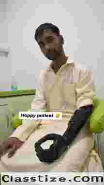 Free Artificial leg In Hyderabad | CareVale Prosthetics