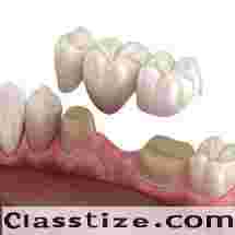 Best Cosmetic bridge treatment in Dubai UAE