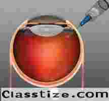 Seeking Macular Degeneration Treatment in Delhi? Contact an Eye Specialist Today