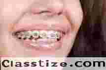 Get Perfect Smile with Dental Braces in Chetla Today  