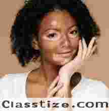  Botox treatment near me - vitiligo treatment - Dermatologist Near Me - tattoo removal near me - hair transplant cost - Lip Injections at RMV - Kosmoderma